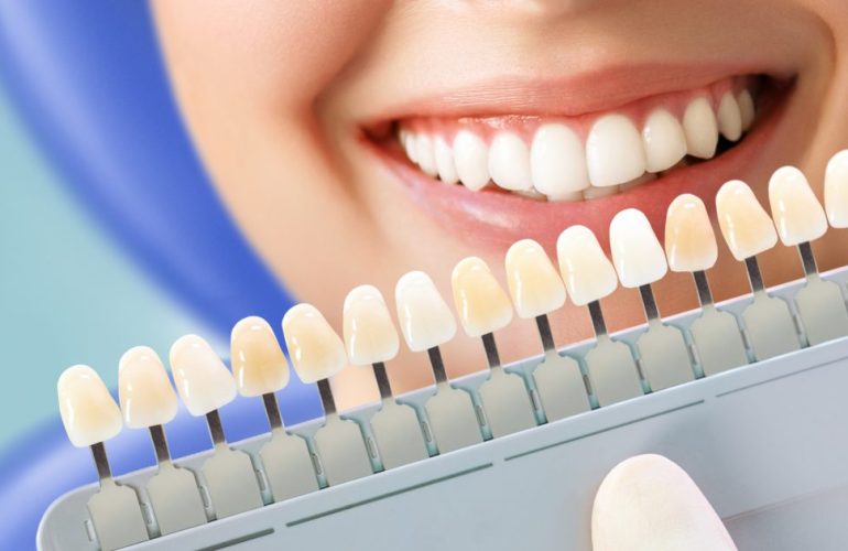 Peroxidmentes, forradalmi technológia a fogfehérítésben: akár 4 árnyalattal fehérebb fogak irritáció nélkül!