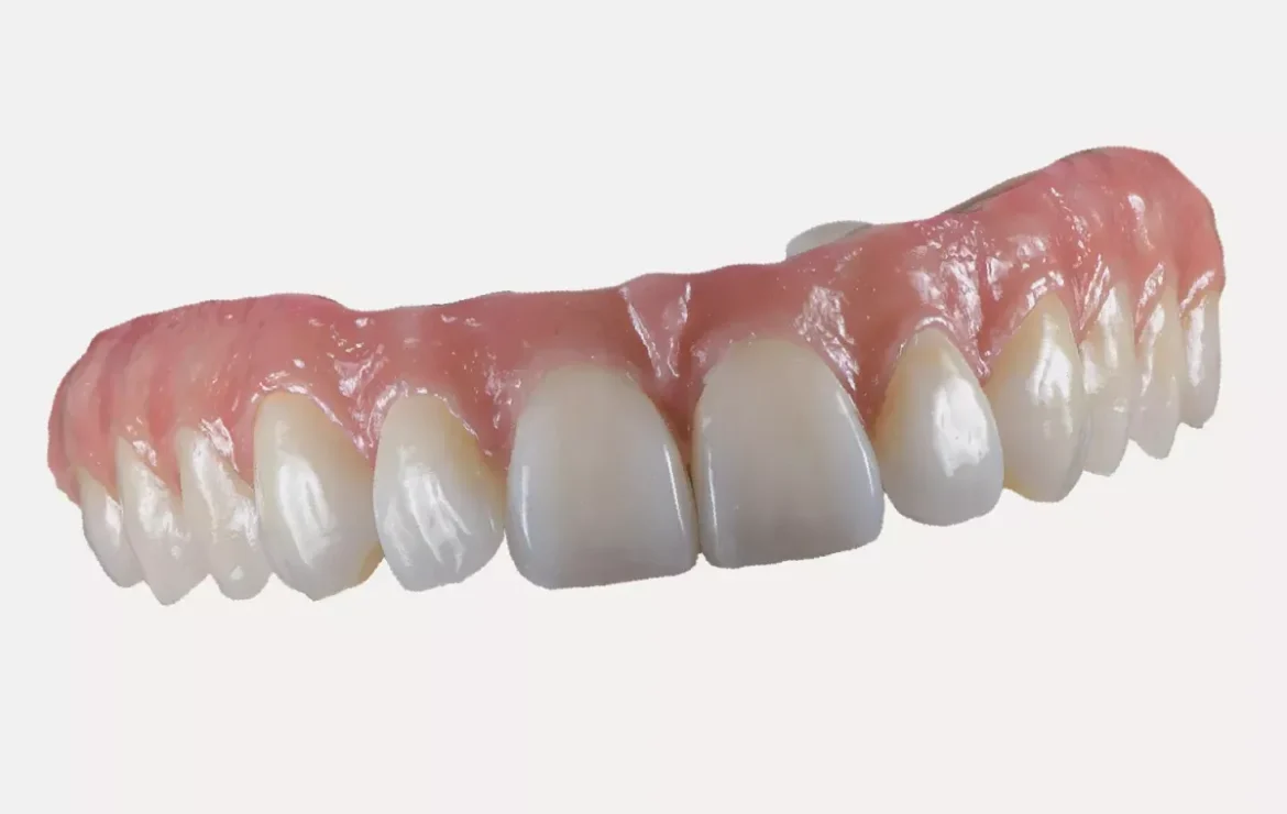 Full arch fogászati beavatkozás – teljes mosoly egyetlen megoldással