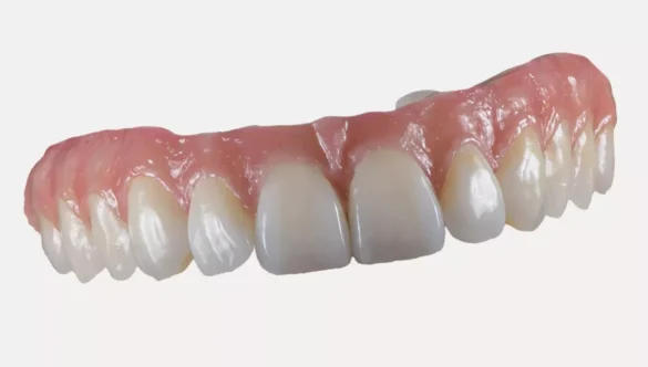 Full arch fogászati beavatkozás – teljes mosoly egyetlen megoldással