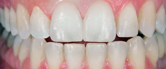 Dentissimi sikeres fogászati kezelés – Fogászat Mosonmagyaróvár