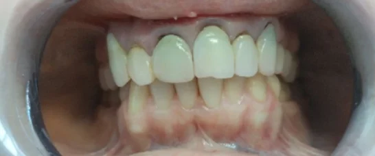 Dentissimi sikeres fogászati kezelés – Fogászat Mosonmagyaróvár