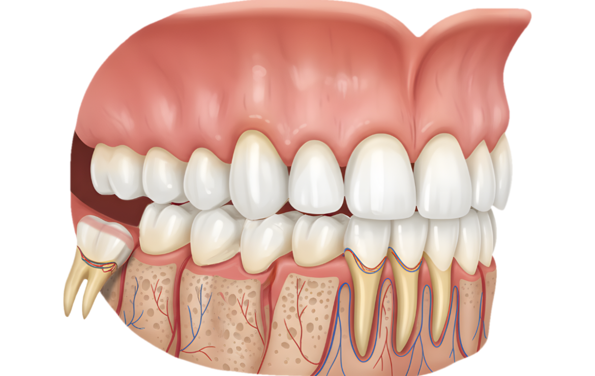 Bölcsességfog eltávolítás után – hasznos tudnivalók az első napokra