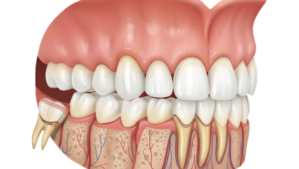 Bölcsességfog eltávolítás után – hasznos tudnivalók az első napokra