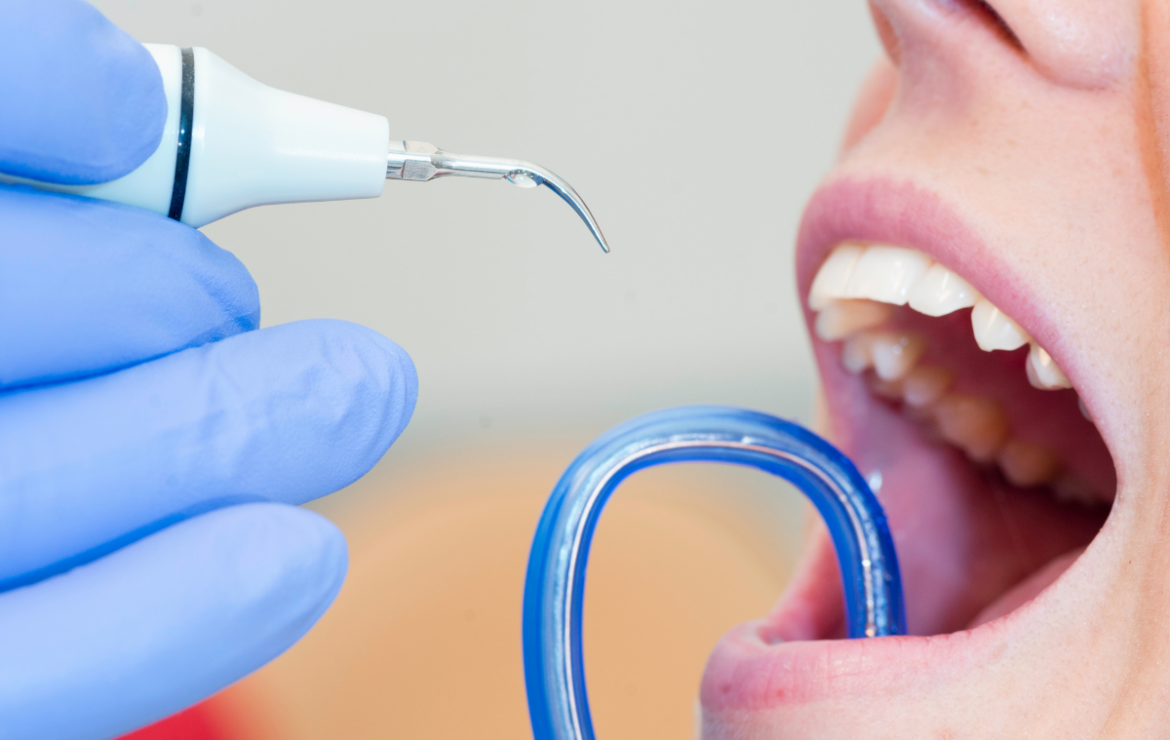 A fogkőeltávolítás jelentősége a mindennapi szájápolásban