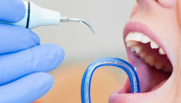 A fogkőeltávolítás jelentősége a mindennapi szájápolásban