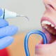 A fogkőeltávolítás jelentősége a mindennapi szájápolásban