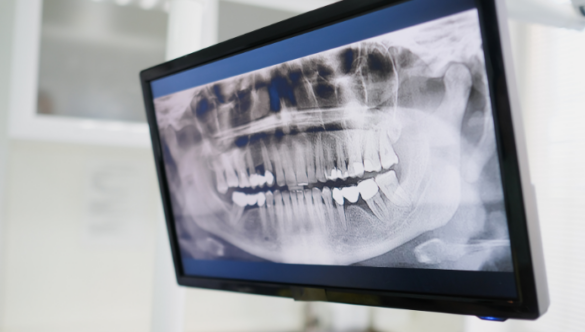 Panorámaröntgen: mikor van rá szükség és mit mutat meg a fogorvosnak?