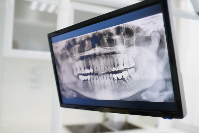 Panorámaröntgen: mikor van rá szükség és mit mutat meg a fogorvosnak?